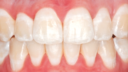 Zähnen auf weiße flecken den Weiße Flecken/Stellen/Punkte